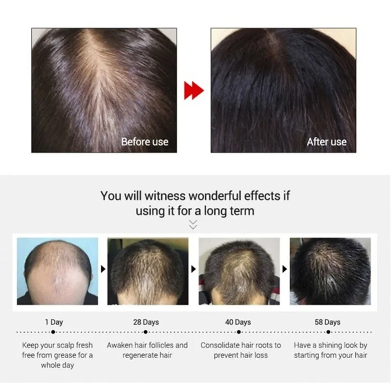 Vlasy Rýchlejšie Opätovný Rast, Zázvor, Olej Sérum Liečbu Vypadávanie Vlasov Prevencia Alopécia Plešatosti Starostlivosť O Vlasy Sprej Rastie Hrubšie Sérum