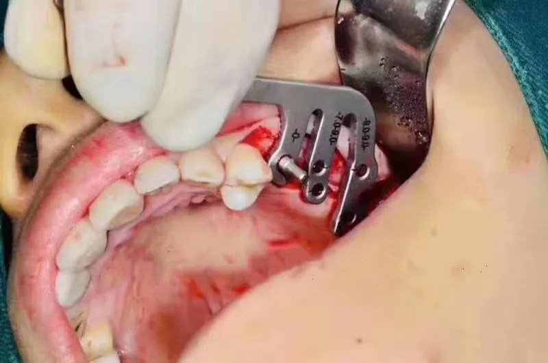 Zubné implantáty nástroje ústne výsadbu polohy sprievodca zubný implantát nástroje výsadbu pozičný uhol pravítko Zubár nástroje