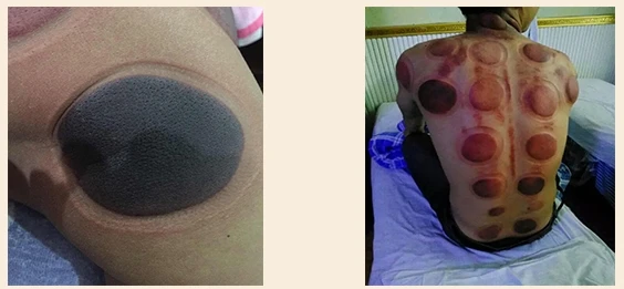 Mongolsko 9 Jar/Set Červená meď Čínskej Lekárskej Vákuové Telo masážneho Acupunture Bankovanie, Vákuové Prenosné Masážne Terapia, bankovanie