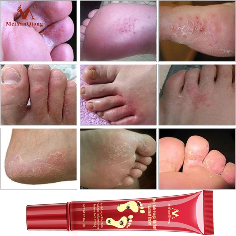 Nohy Bylinné Liečby Proti Plesňové Infekcie Onychomycosis Paronychia Účinné Prst Huba Liečba Nohy Opravy Krém na starostlivosť o nohy